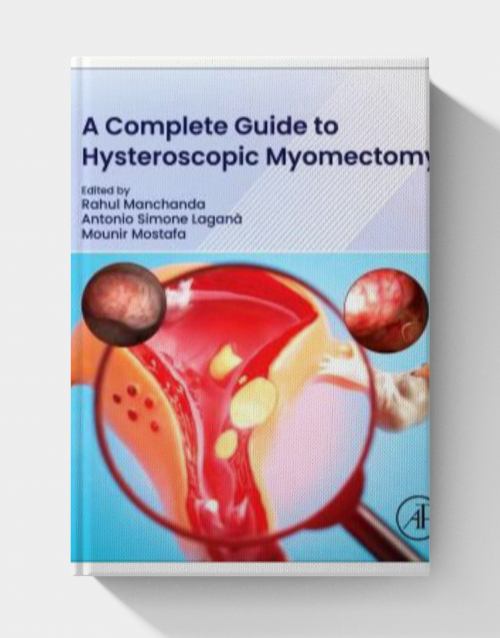A Complete Guide to Hysteroscopic Myomectomy