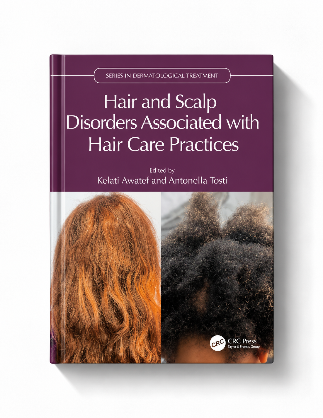 Hair and Scalp Disorders Associated with Hair Care Practices